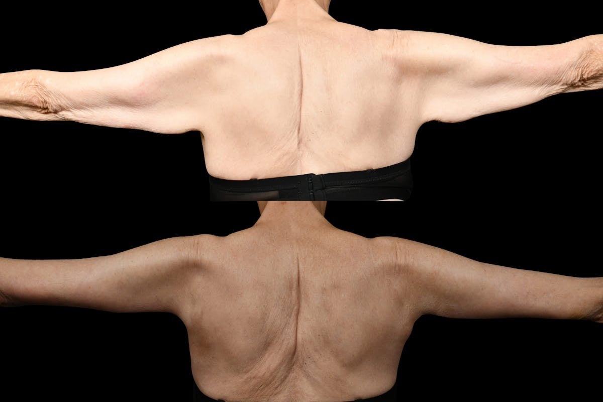 Arm Lift Before & After Gallery - Patient 119053 - Image 2