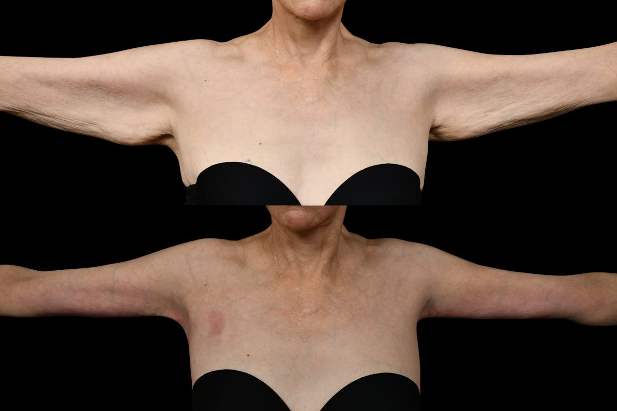 Arm Lift Before & After Gallery - Patient 119053 - Image 1