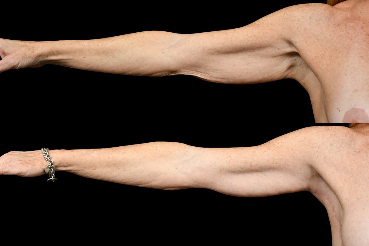 Arm Lift Before & After Gallery - Patient 324544 - Image 1