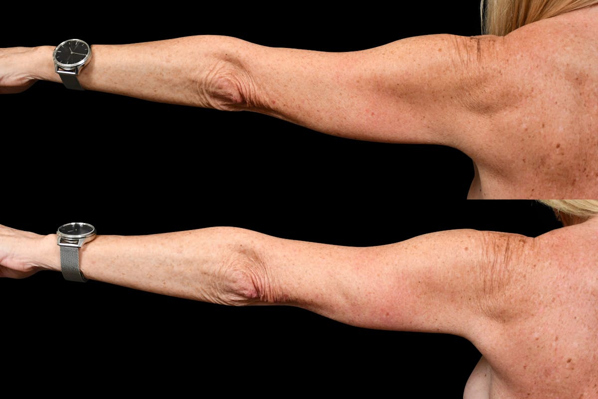 Arm Lift Before & After Gallery - Patient 324544 - Image 3