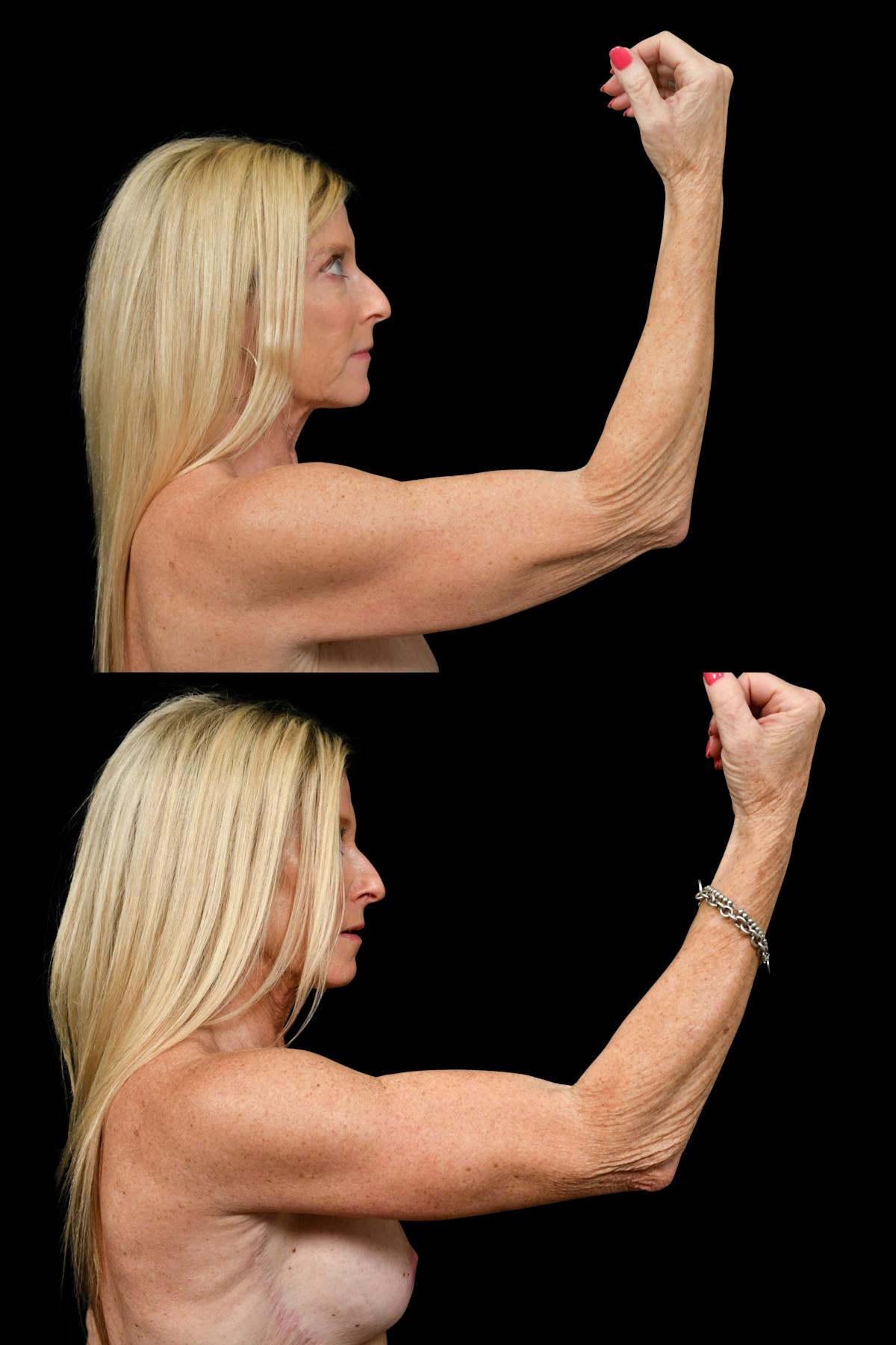 Arm Lift Before & After Gallery - Patient 324544 - Image 4