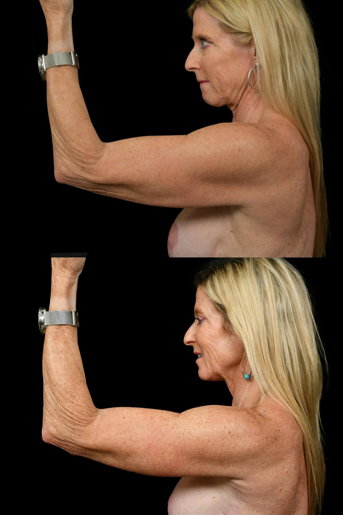 Arm Lift Before & After Gallery - Patient 324544 - Image 5