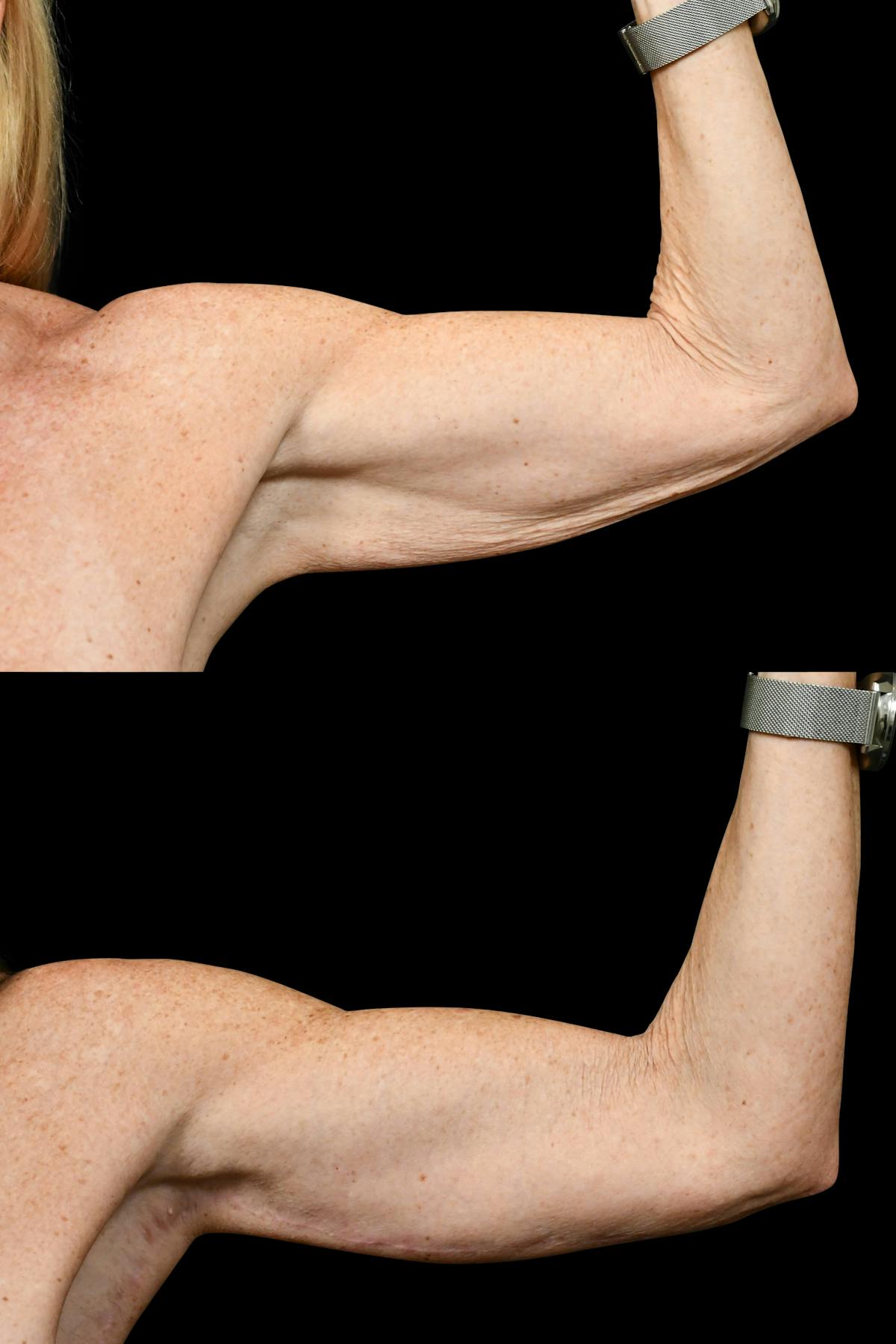 Arm Lift Before & After Gallery - Patient 324544 - Image 4