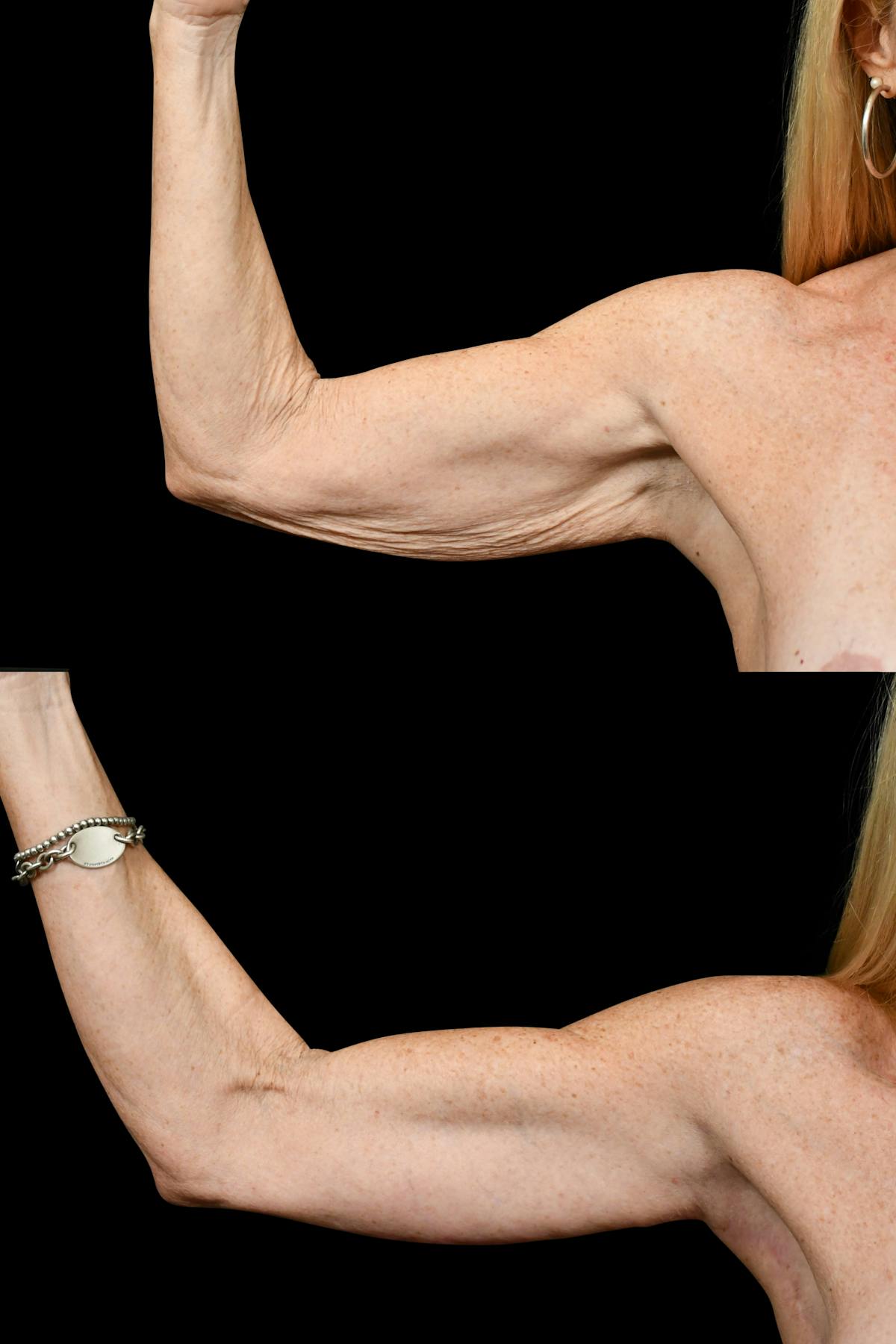 Arm Lift Before & After Gallery - Patient 324544 - Image 5