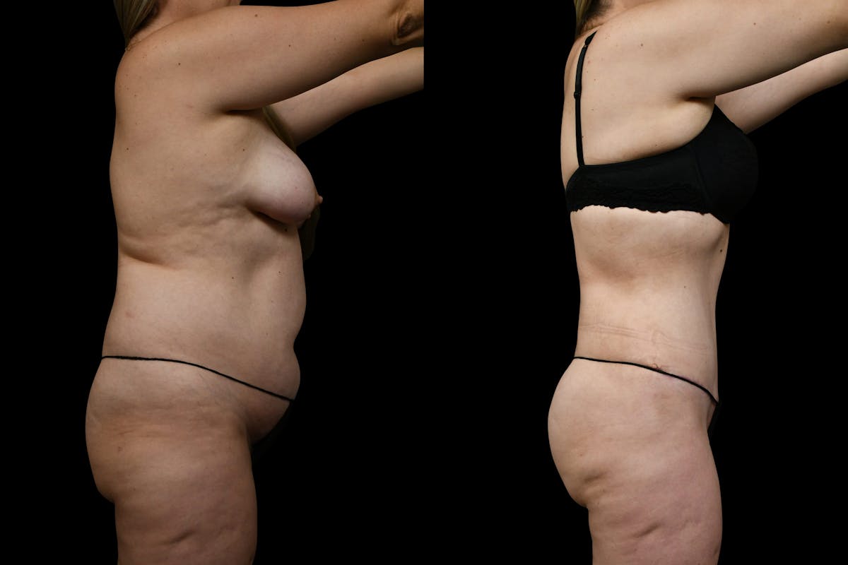 Butt Augmentation Before & After Gallery - Patient 267985 - Image 4