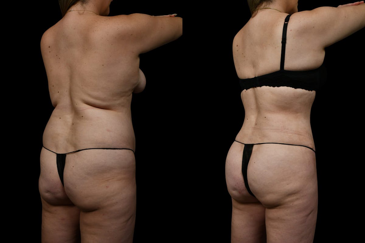Butt Augmentation Before & After Gallery - Patient 267985 - Image 1