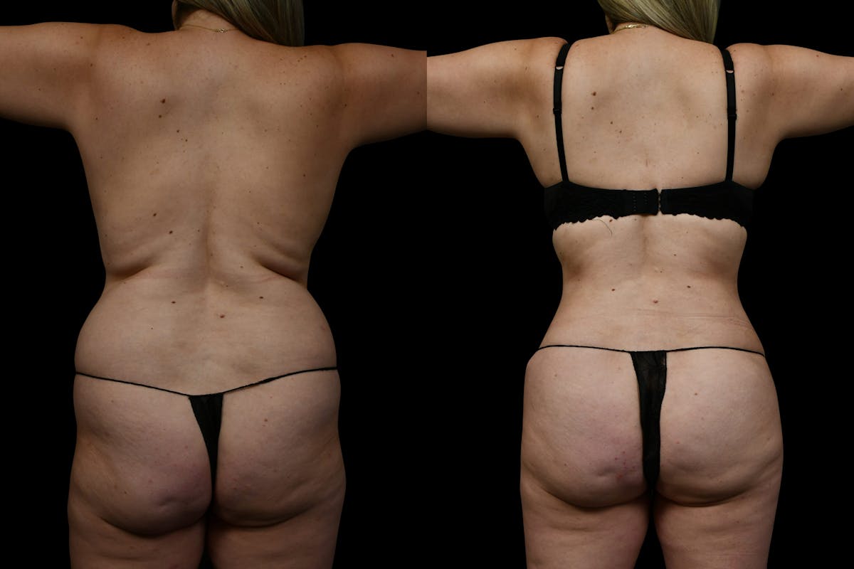 Butt Augmentation Before & After Gallery - Patient 267985 - Image 3