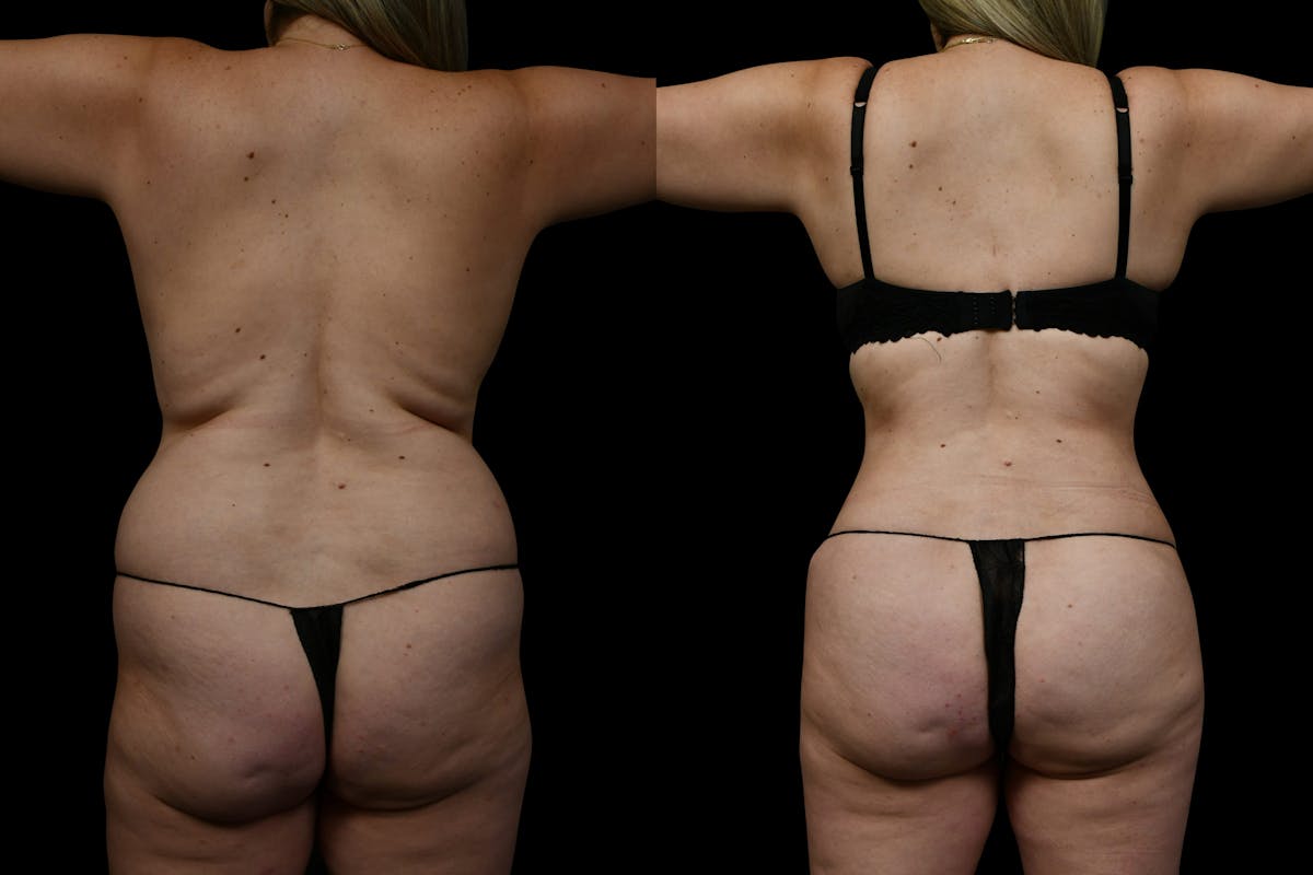 Fat Grafting - Butt Augmentation Before & After Gallery - Patient 267985 - Image 1