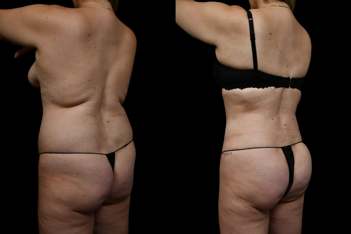 Butt Augmentation Before & After Gallery - Patient 267985 - Image 2