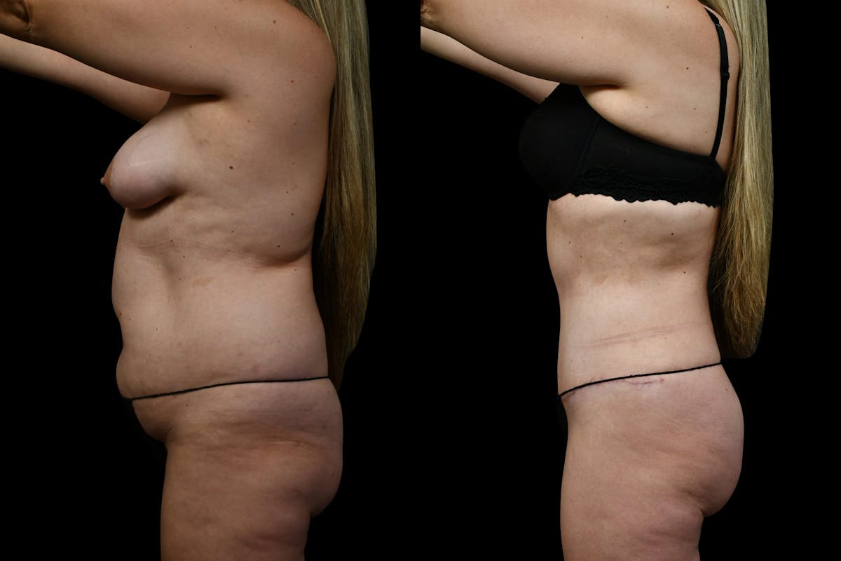 Butt Augmentation Before & After Gallery - Patient 267985 - Image 5