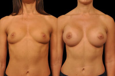 Breast Augmentation Before & After Gallery - Patient 158580 - Image 1