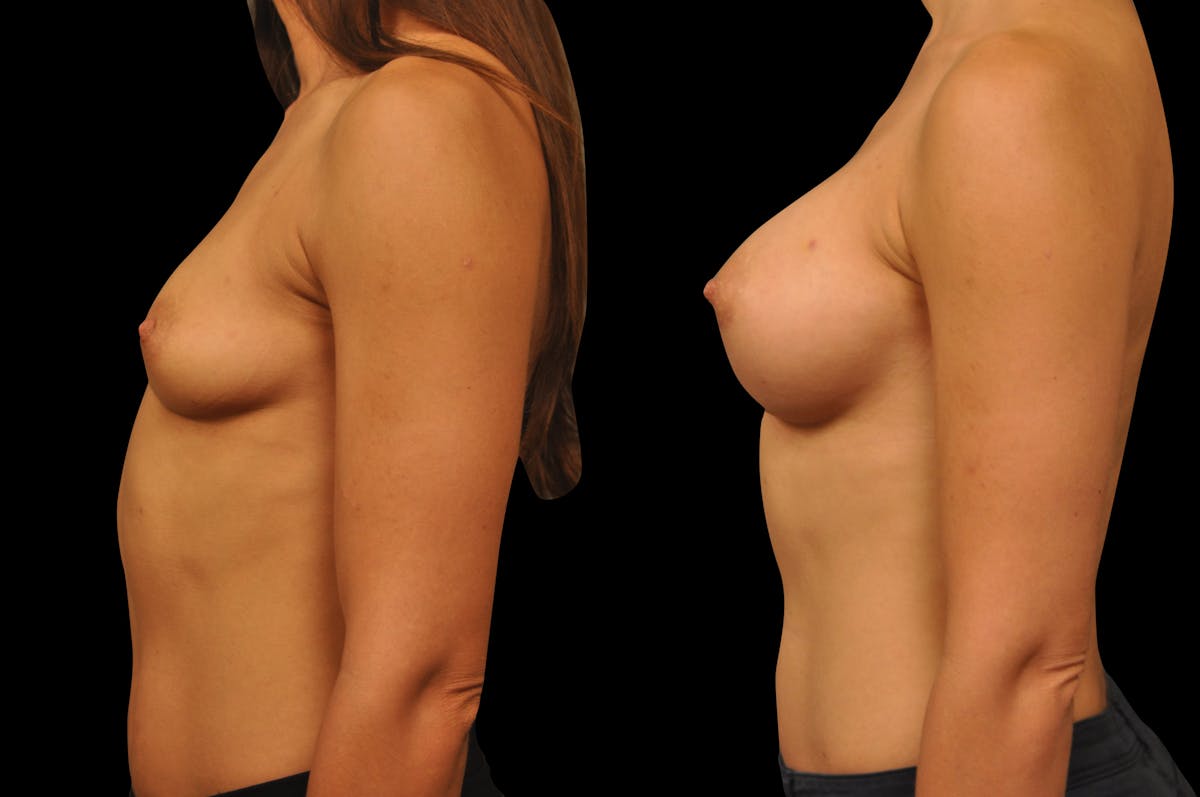 Breast Augmentation Before & After Gallery - Patient 158580 - Image 5