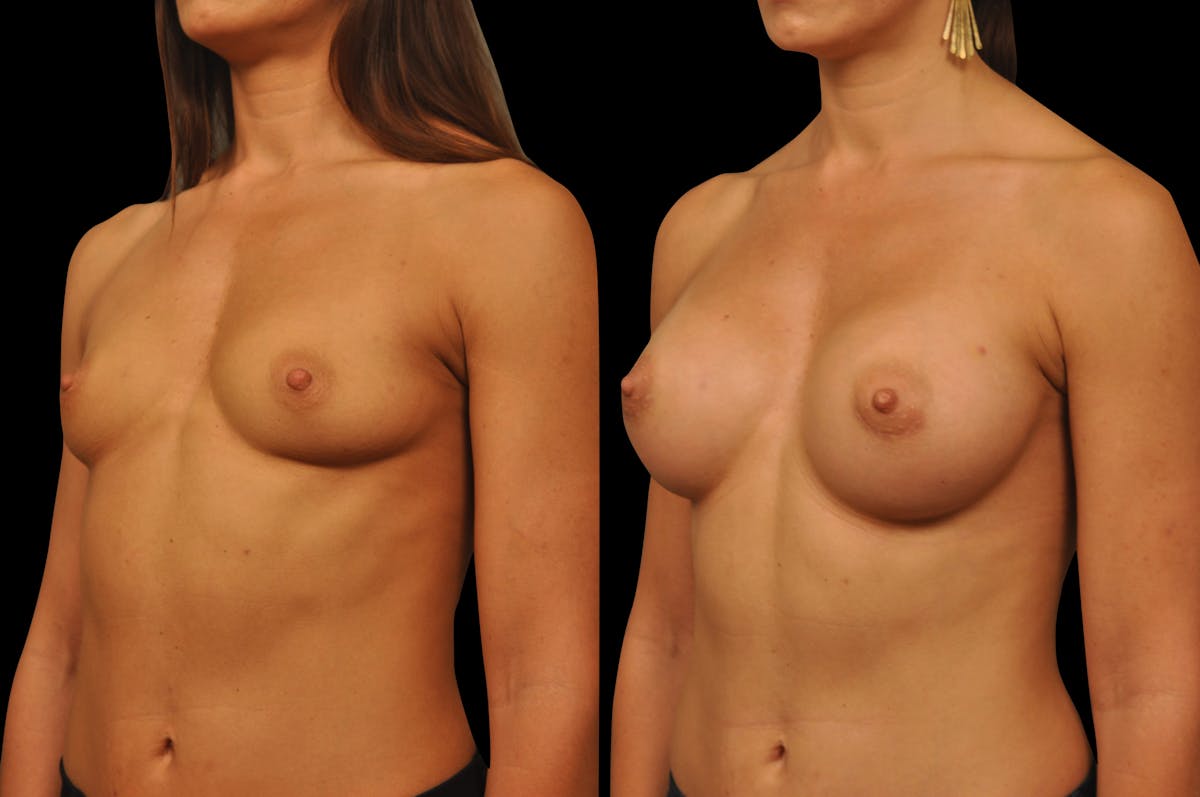 Breast Augmentation Before & After Gallery - Patient 158580 - Image 4