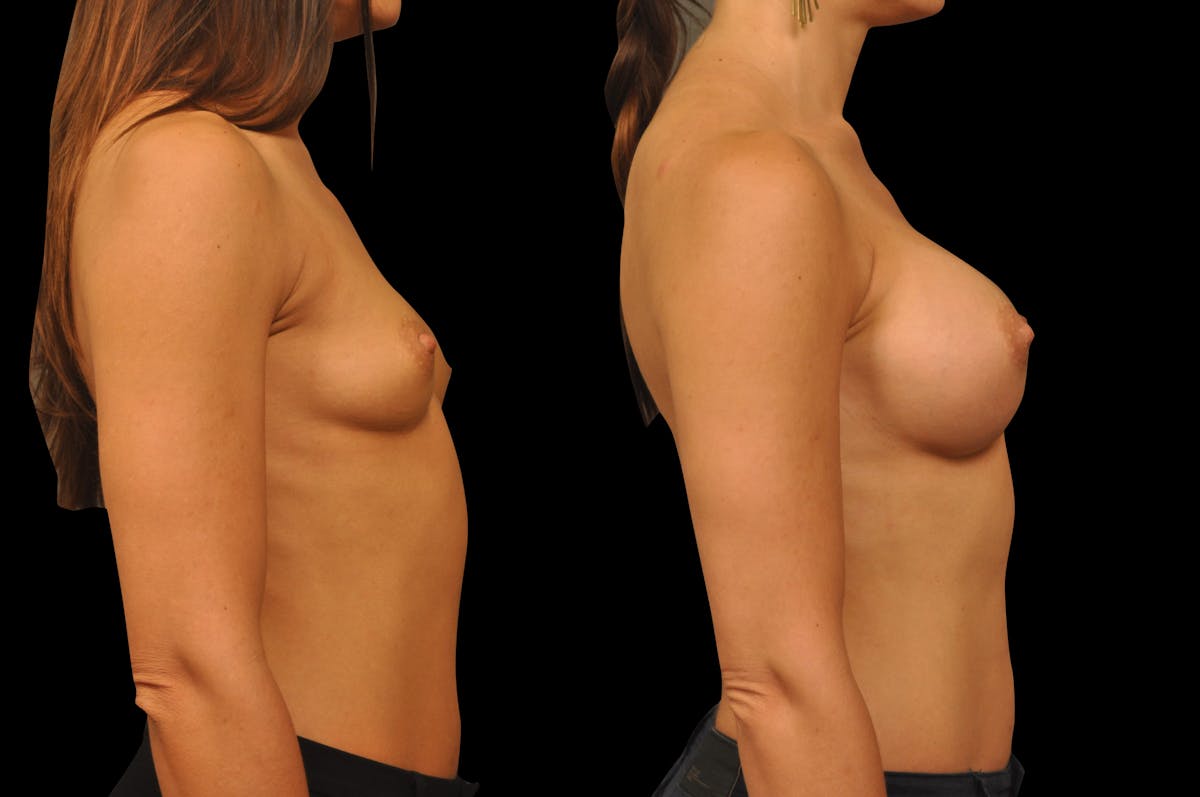 Breast Augmentation Before & After Gallery - Patient 158580 - Image 3