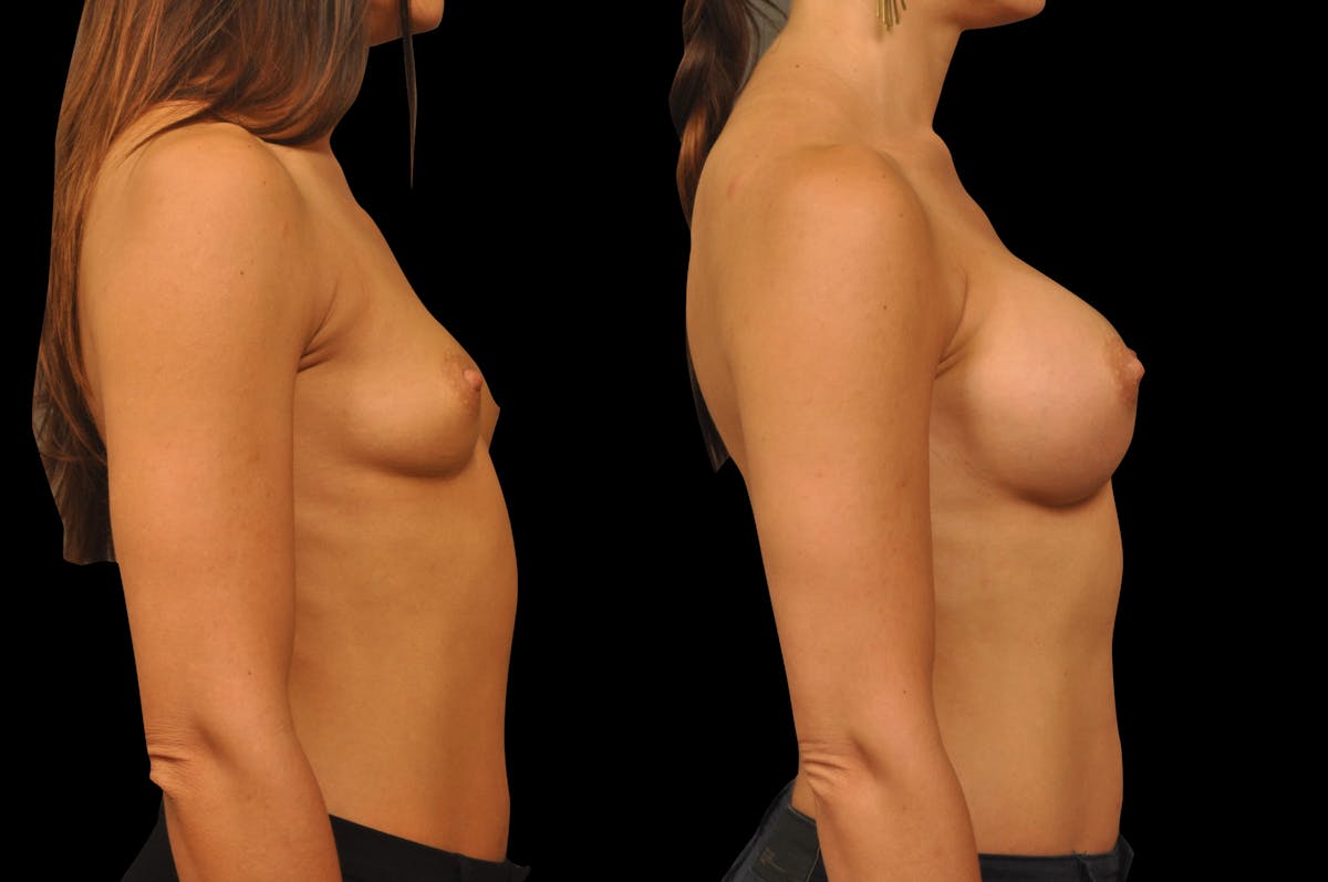 Breast Augmentation Before & After Gallery - Patient 158580 - Image 4