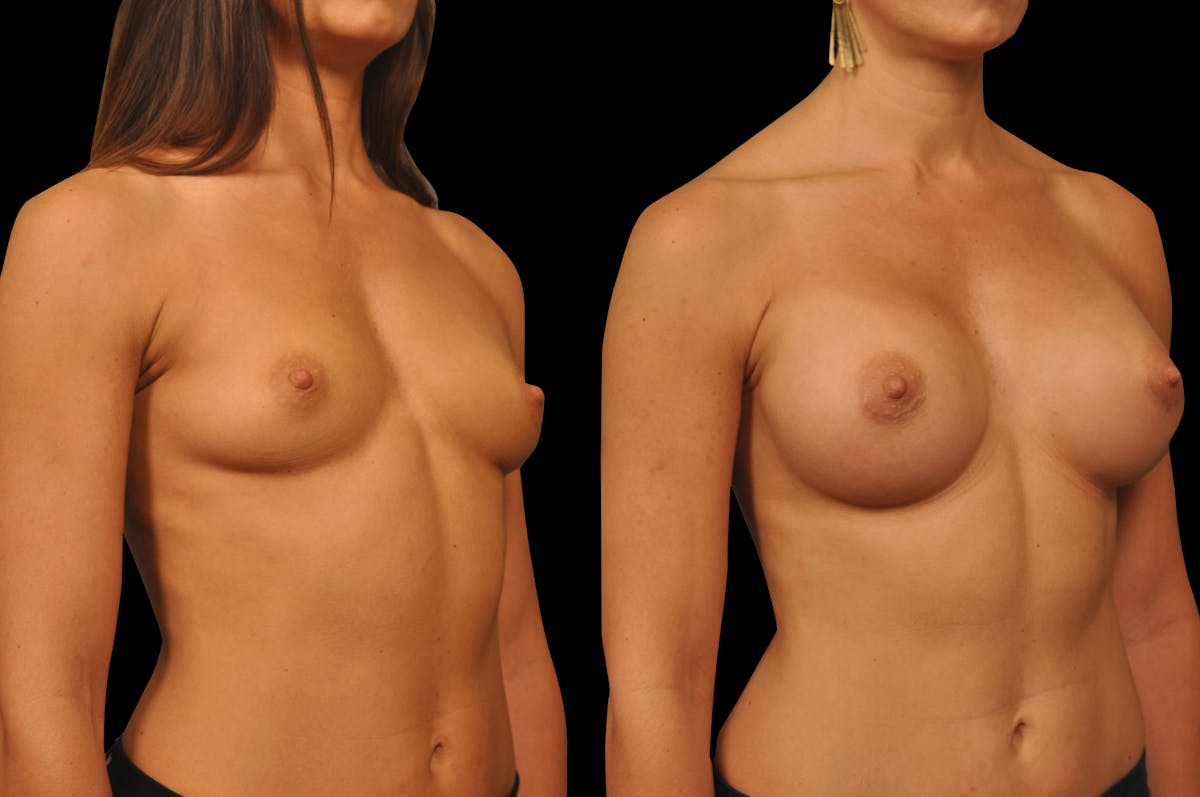 Breast Augmentation Before & After Gallery - Patient 158580 - Image 5