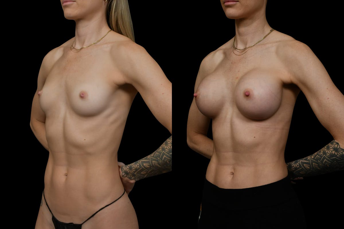 Breast Augmentation Before & After Gallery - Patient 276245 - Image 5