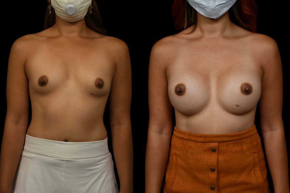 Breast Augmentation Before & After Gallery - Patient 353957 - Image 1