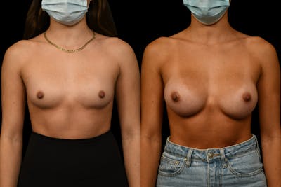 Breast Augmentation Before & After Gallery - Patient 972124 - Image 1