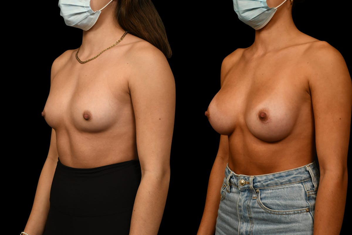 Breast Augmentation Before & After Gallery - Patient 972124 - Image 3