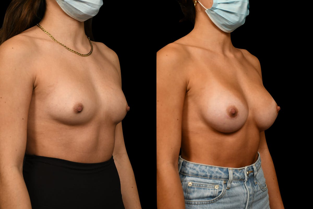 Breast Augmentation Before & After Gallery - Patient 972124 - Image 5