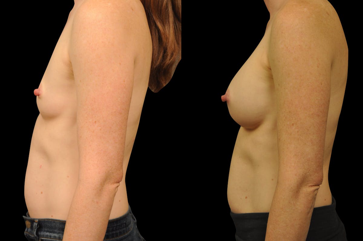 Breast Augmentation Before & After Gallery - Patient 134586 - Image 5
