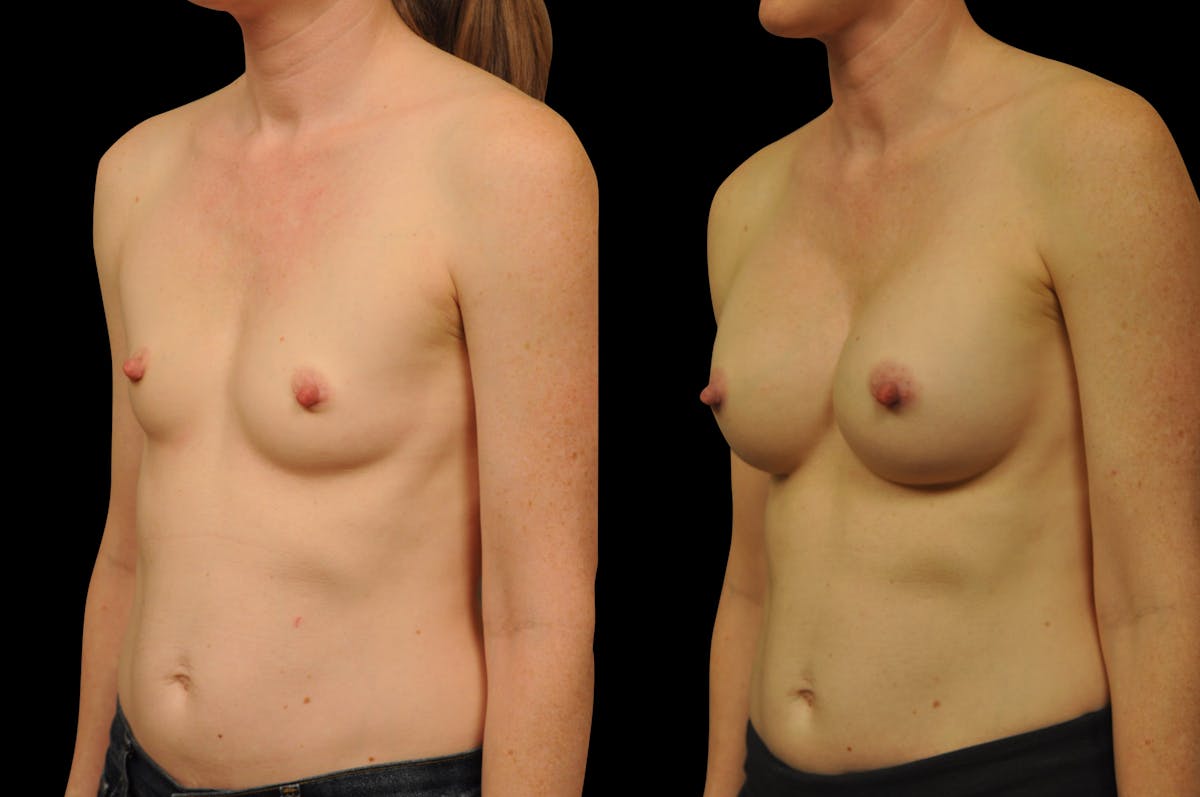 Breast Augmentation Before & After Gallery - Patient 134586 - Image 4