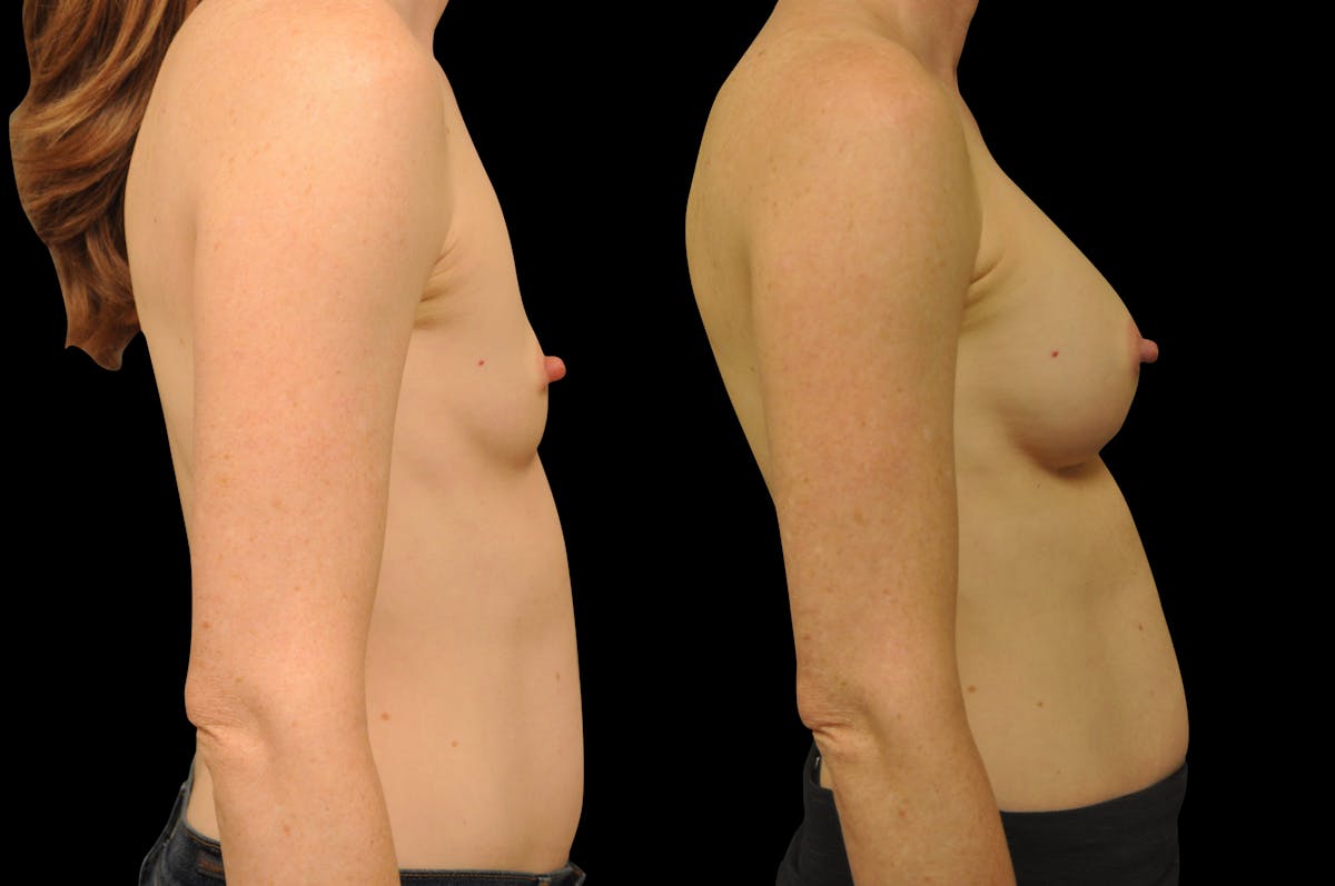 Breast Augmentation Before & After Gallery - Patient 134586 - Image 4