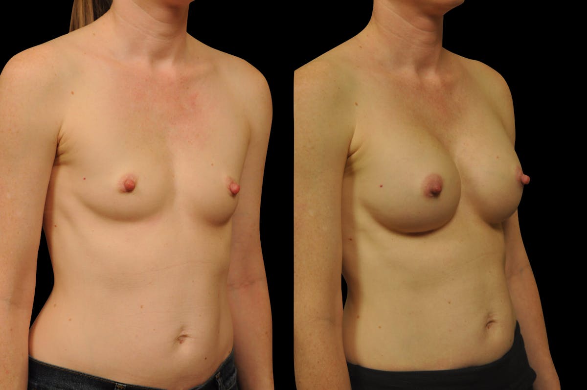 Breast Augmentation Before & After Gallery - Patient 134586 - Image 2