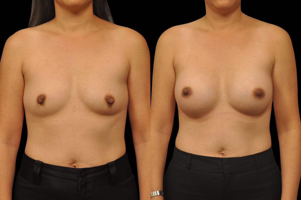 Breast Augmentation Before & After Gallery - Patient 329755 - Image 1