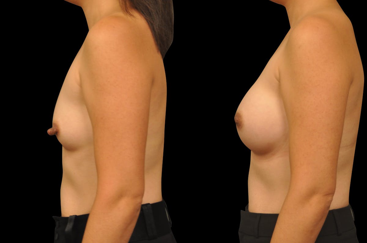 Breast Augmentation Before & After Gallery - Patient 329755 - Image 2