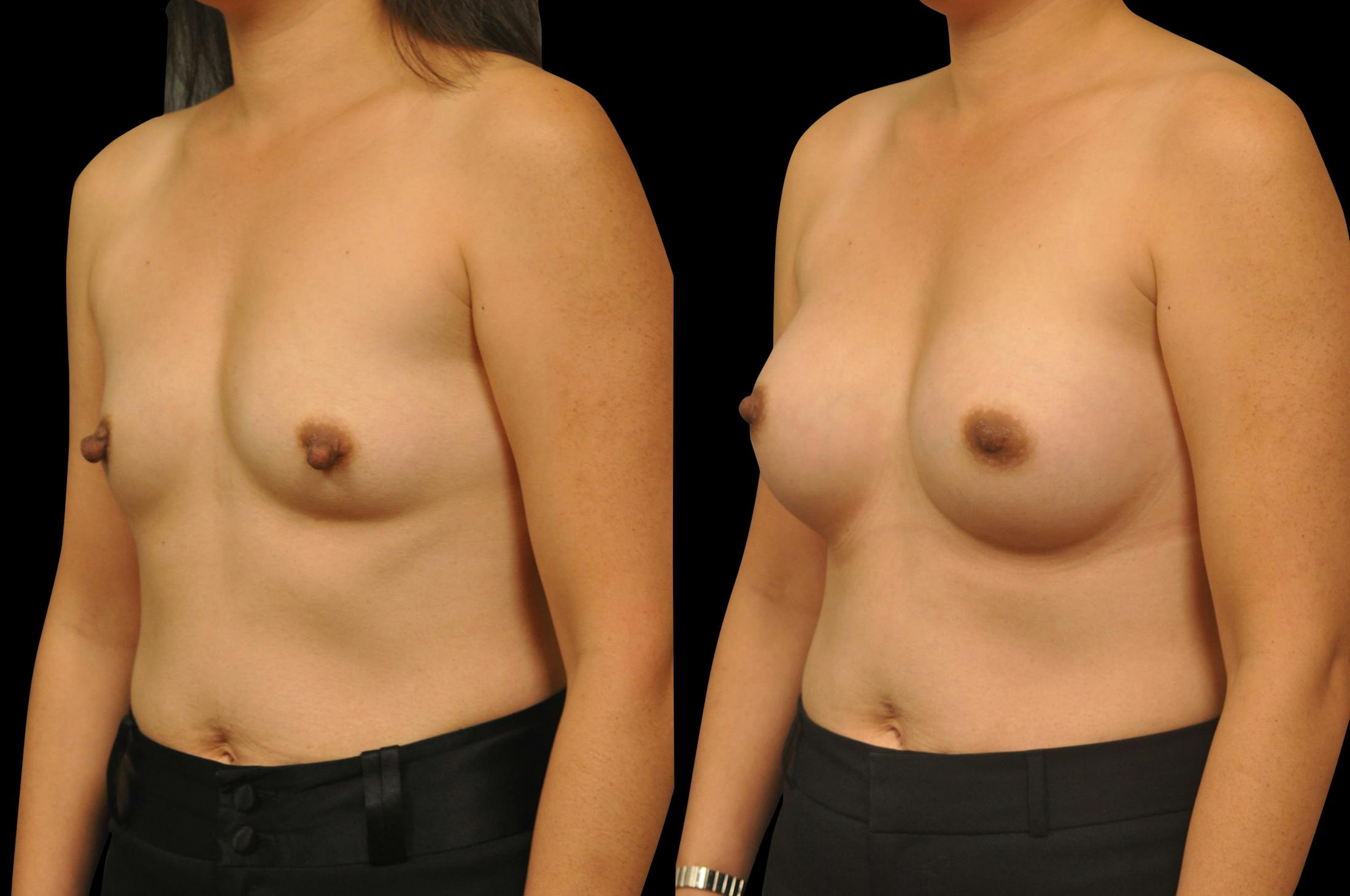 Breast Augmentation Before & After Gallery - Patient 329755 - Image 4