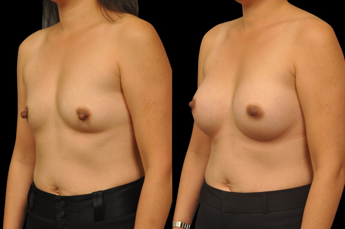 Breast Augmentation Before & After Gallery - Patient 329755 - Image 3