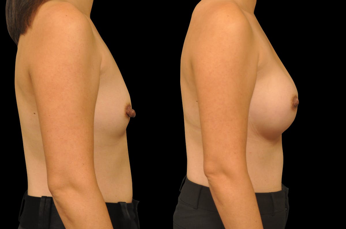 Breast Augmentation Before & After Gallery - Patient 329755 - Image 4