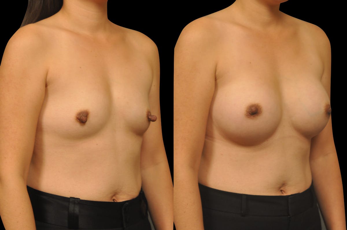 Breast Augmentation Before & After Gallery - Patient 329755 - Image 5