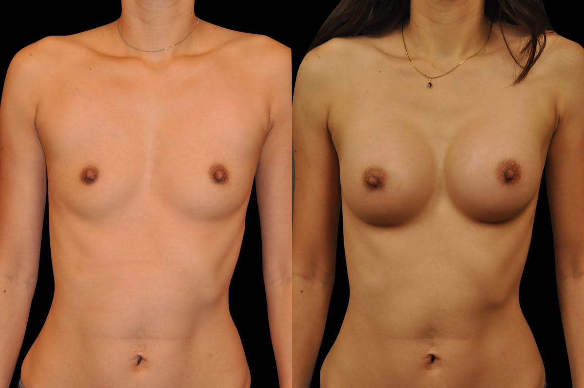 Breast Augmentation Before & After Gallery - Patient 795221 - Image 1