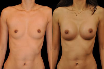 Breast Augmentation Before & After Gallery - Patient 795221 - Image 1