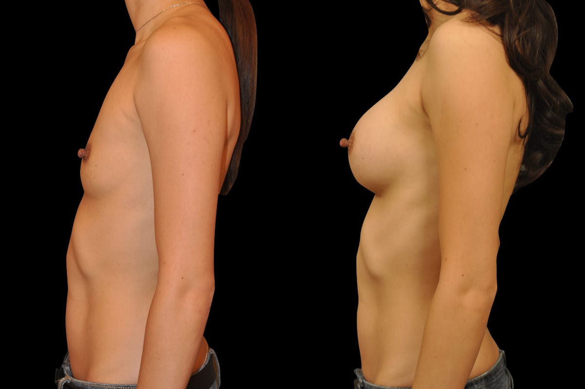 Breast Augmentation Before & After Gallery - Patient 795221 - Image 2