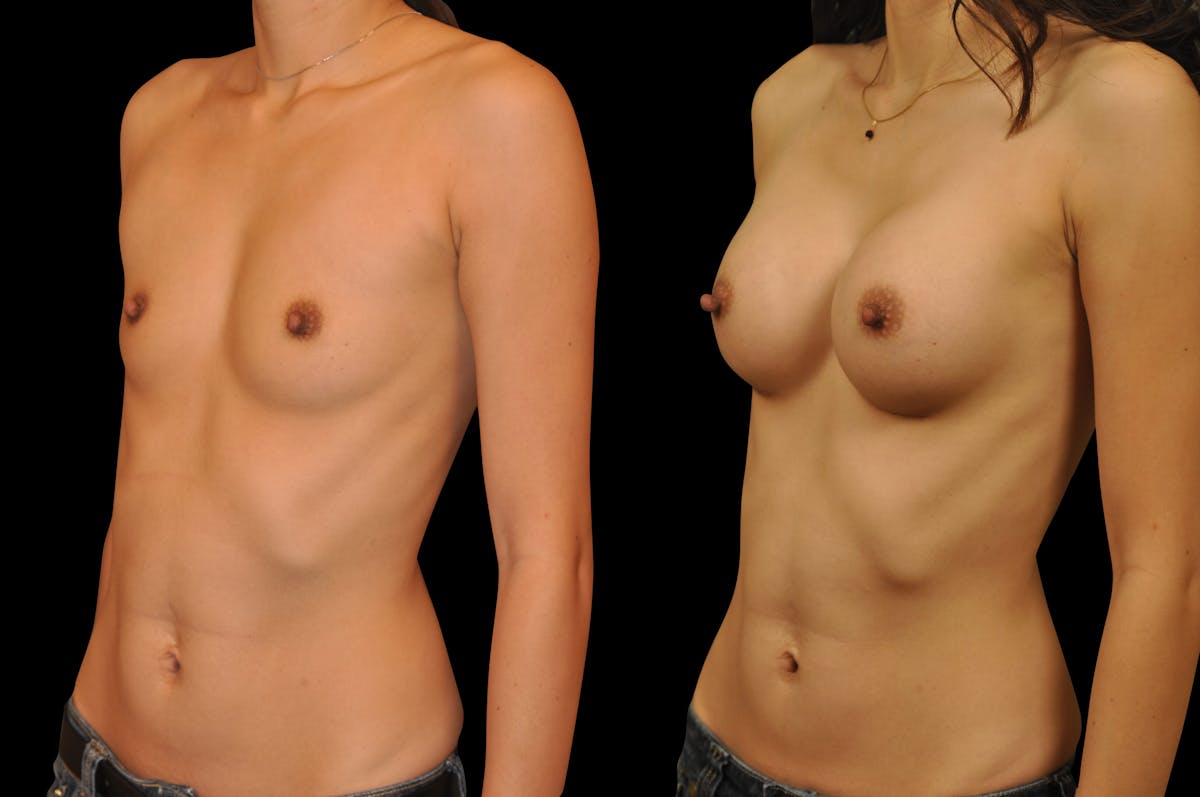 Breast Augmentation Before & After Gallery - Patient 795221 - Image 4