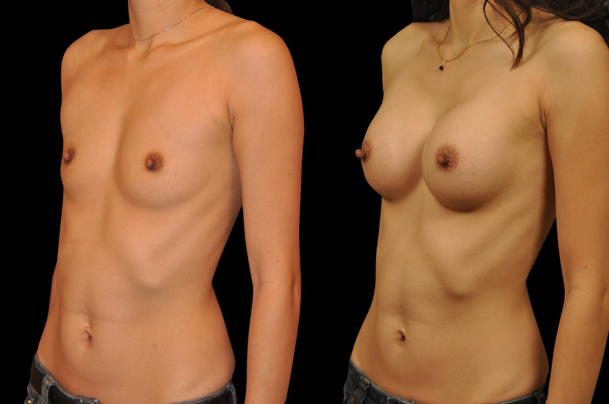 Breast Augmentation Before & After Gallery - Patient 795221 - Image 3