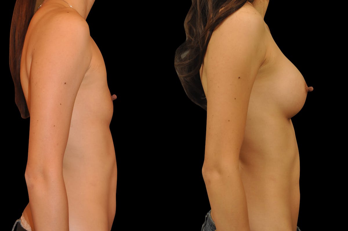 Breast Augmentation Before & After Gallery - Patient 795221 - Image 4