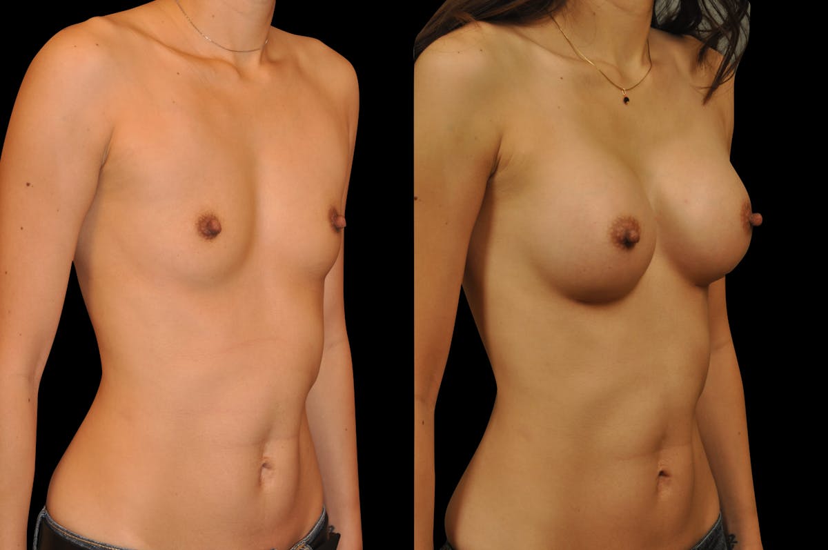 Breast Augmentation Before & After Gallery - Patient 795221 - Image 2