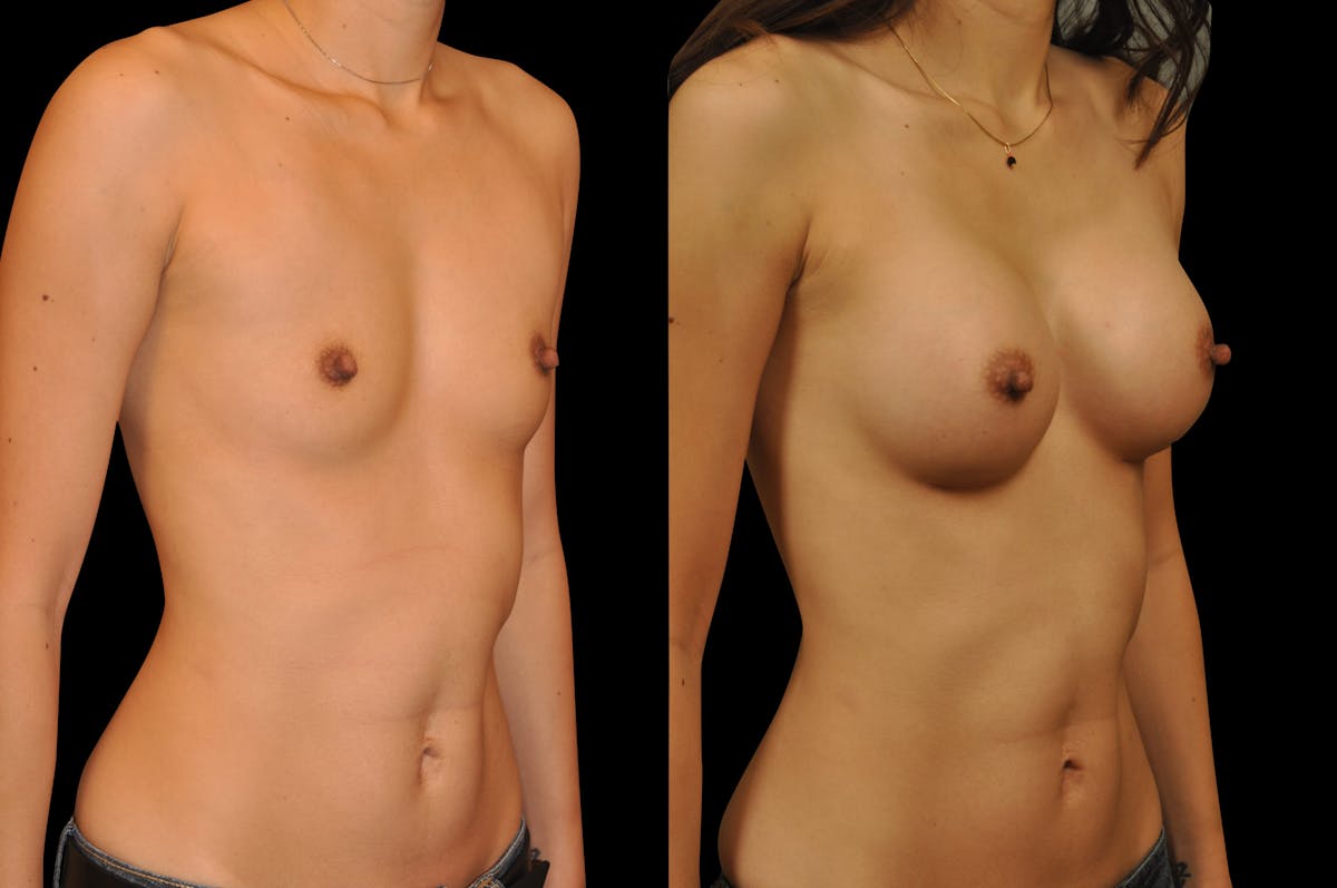 Breast Augmentation Before & After Gallery - Patient 795221 - Image 5