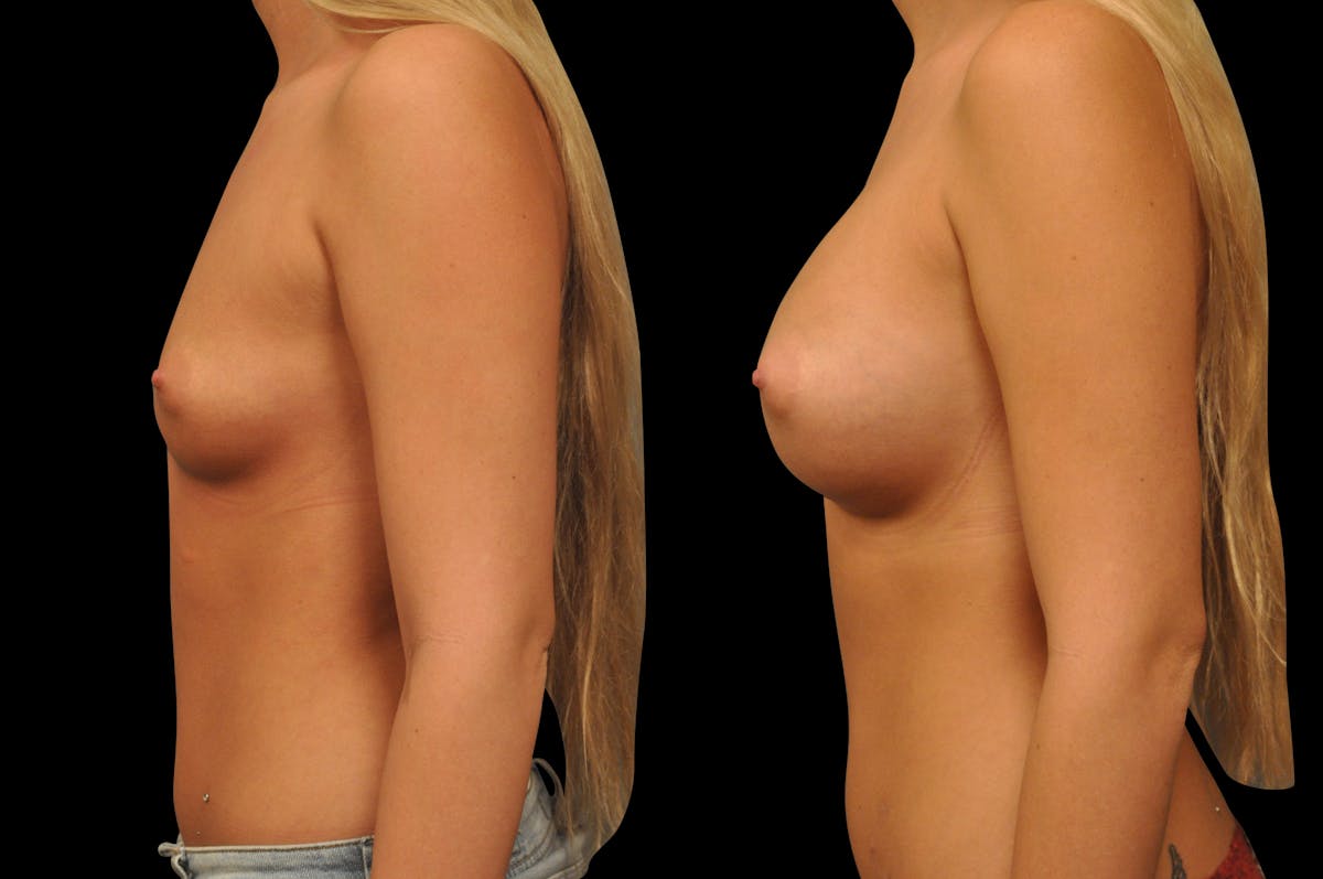 Breast Augmentation Before & After Gallery - Patient 142095 - Image 4