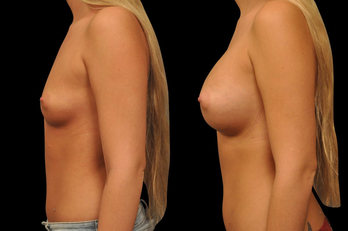 Breast Augmentation Before & After Gallery - Patient 142095 - Image 2