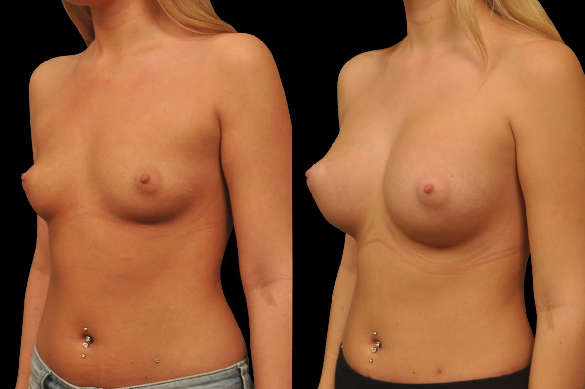 Breast Augmentation Before & After Gallery - Patient 142095 - Image 5