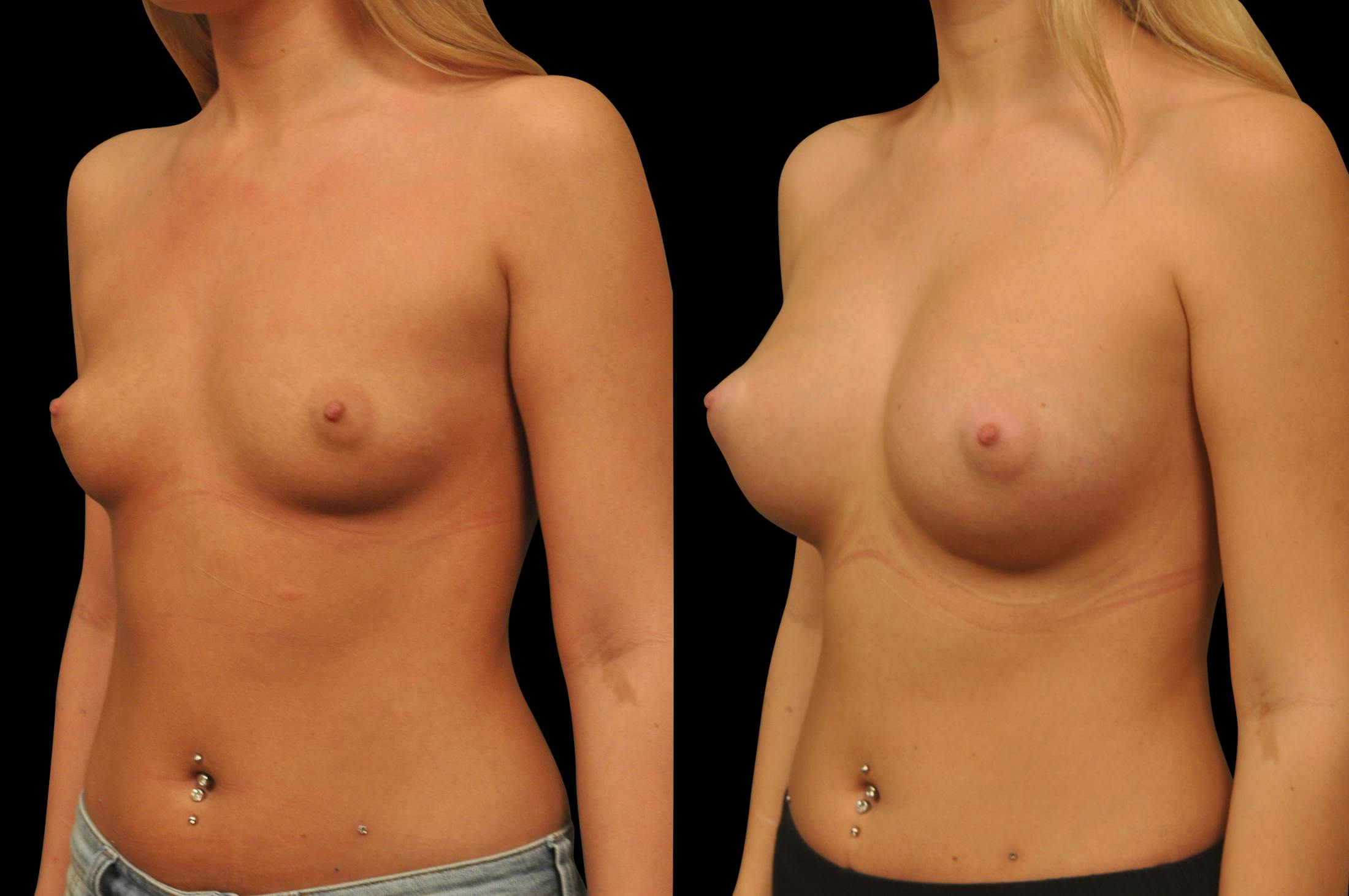 Breast Augmentation Before & After Gallery - Patient 142095 - Image 5