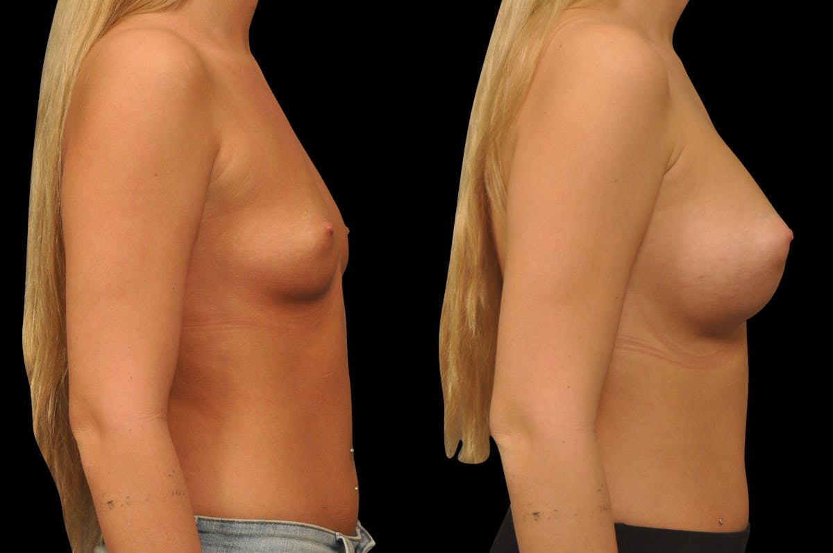 Breast Augmentation Before & After Gallery - Patient 142095 - Image 3