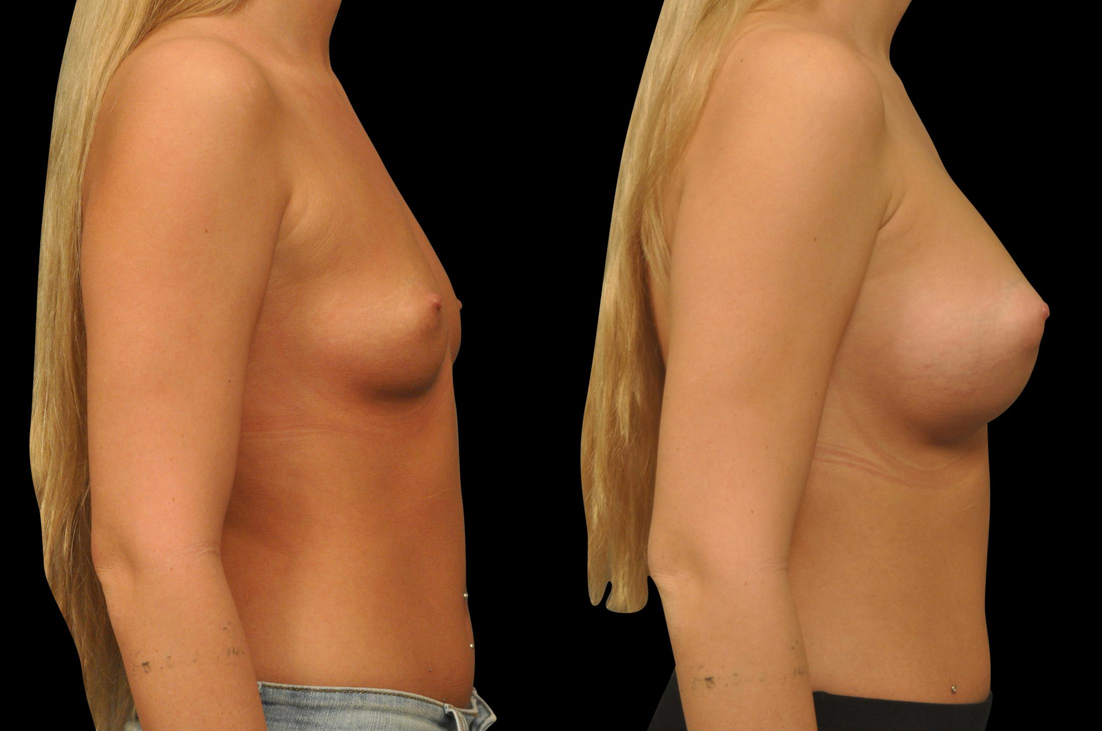 Breast Augmentation Before & After Gallery - Patient 142095 - Image 3