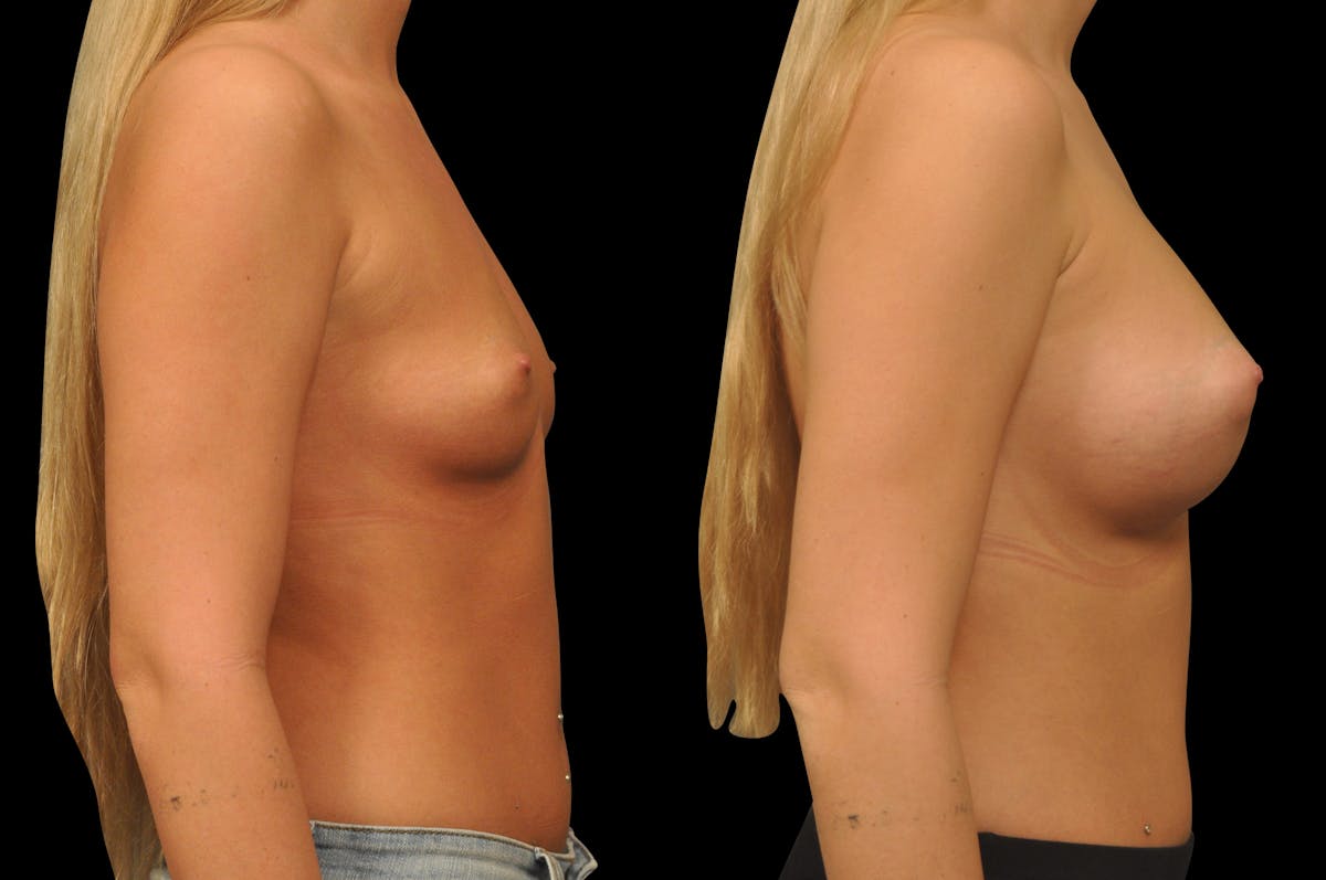 Breast Augmentation Before & After Gallery - Patient 142095 - Image 4